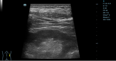 术后超声复查,示肾周及集合系统结构清晰,未见异常征象。 术后超声复查,示肾周及集合系统结构清晰,未见异常征象。